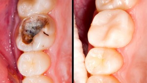 Voici Comment Vous Pouvez Traiter Naturellement Une Carie Dentaire