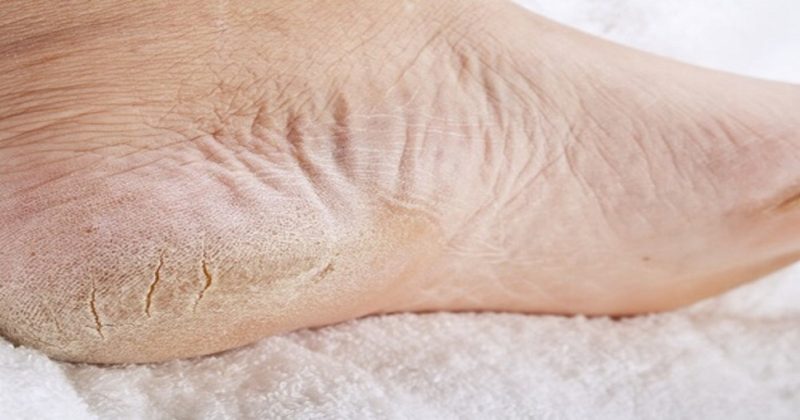 Un Remède Naturel Pour Les Pieds Secs - NewsMAG